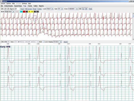 Holter LX Analysis